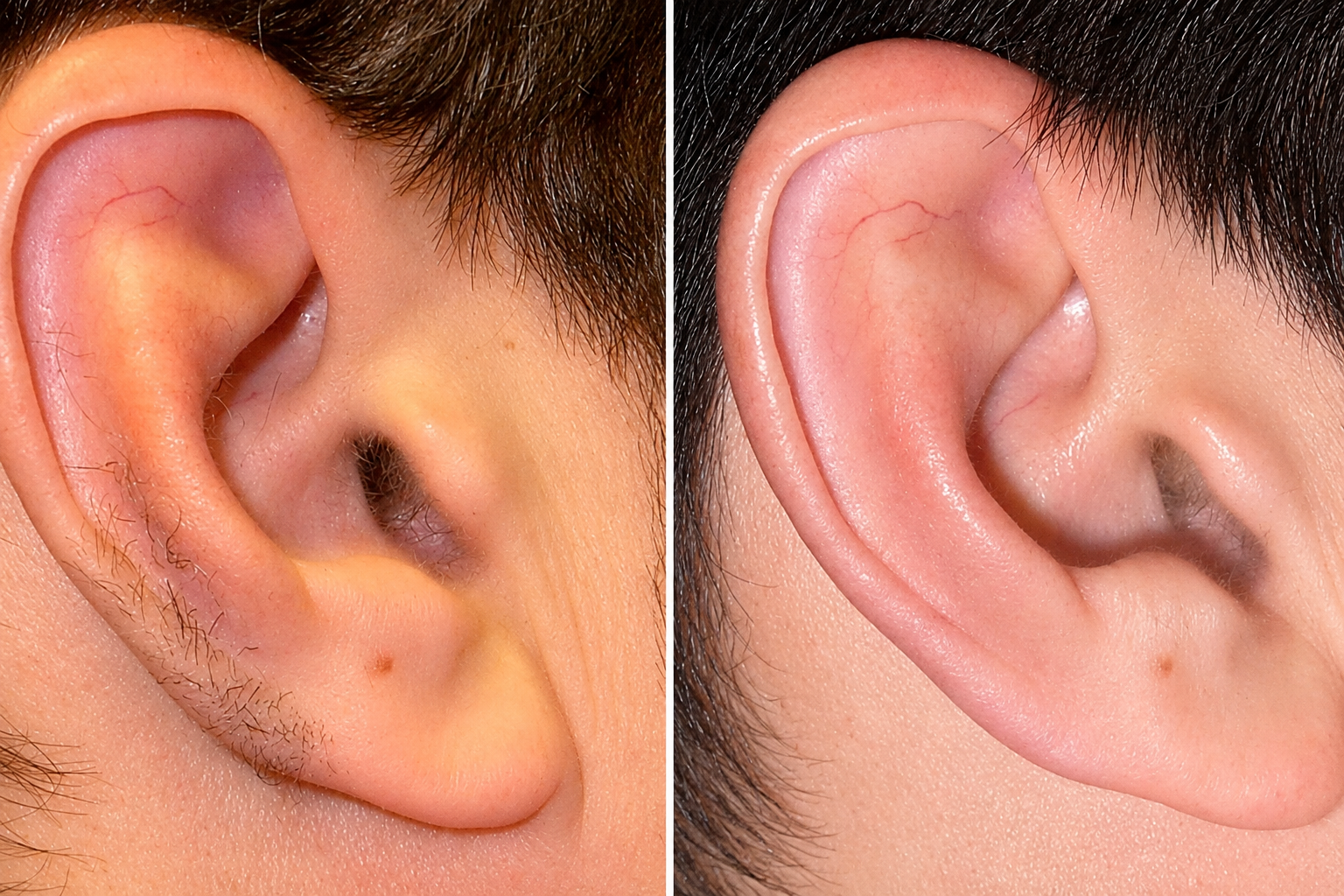 Ear Hair Removal Result