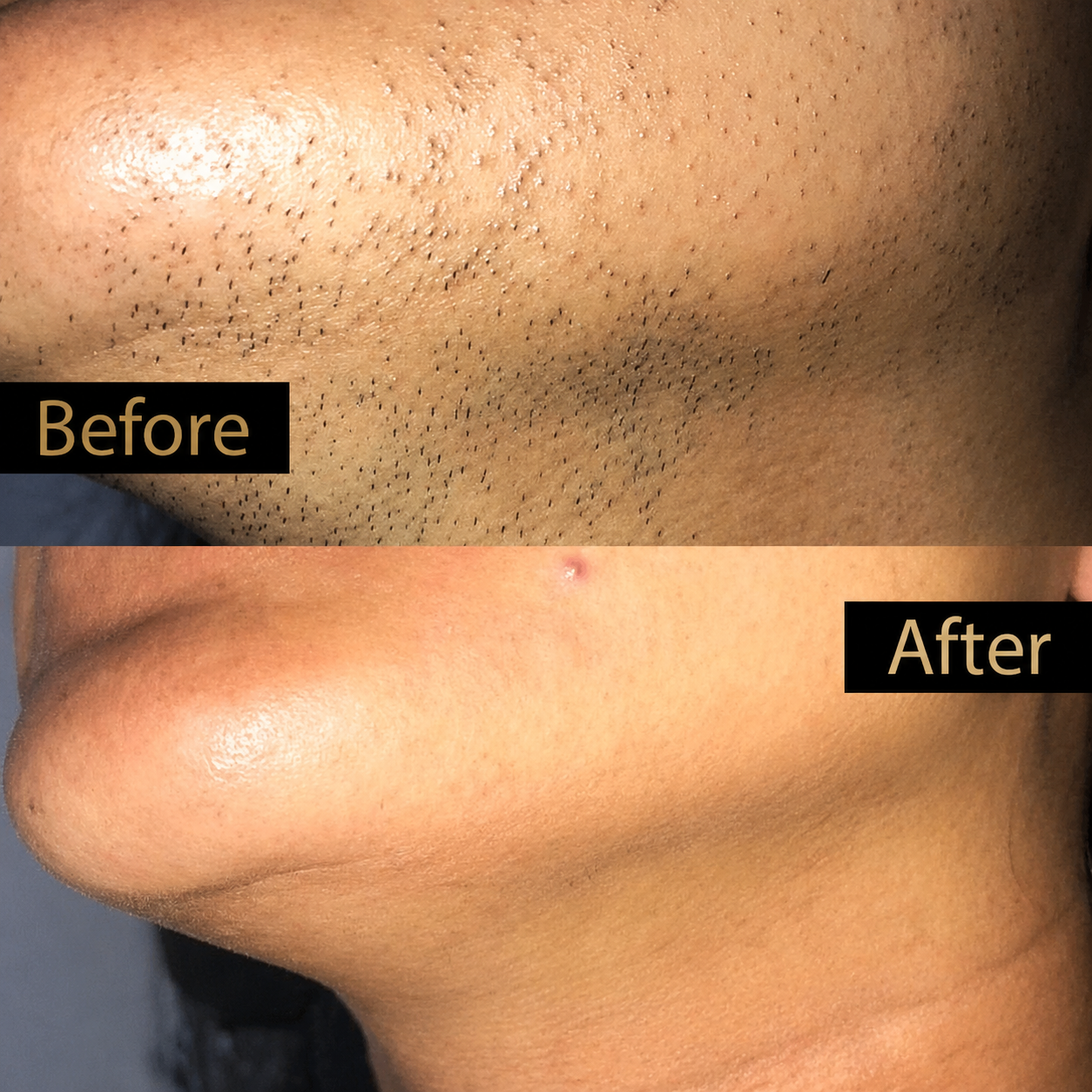 Underchin Hair Removal Result