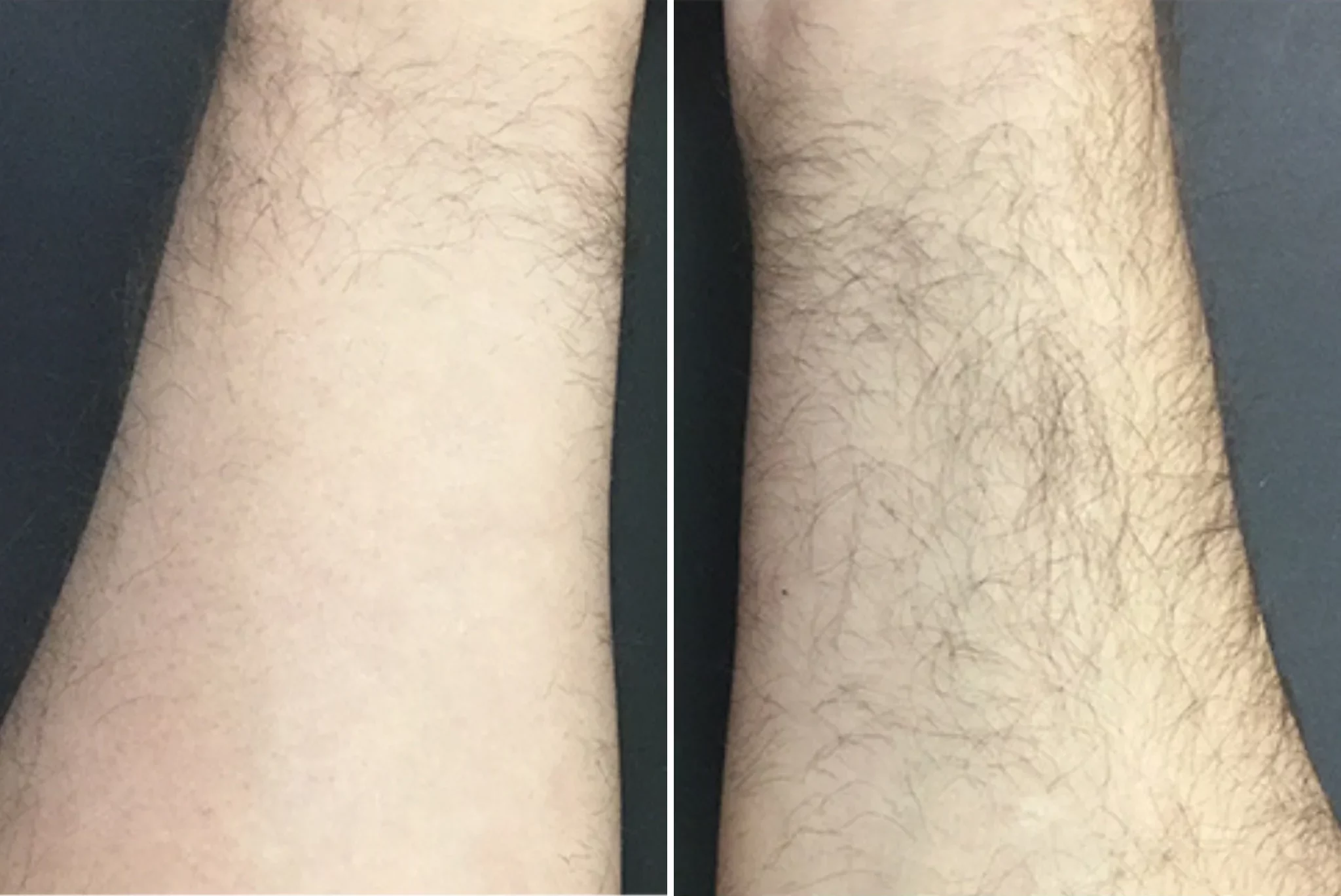Hand Hair Removal Result