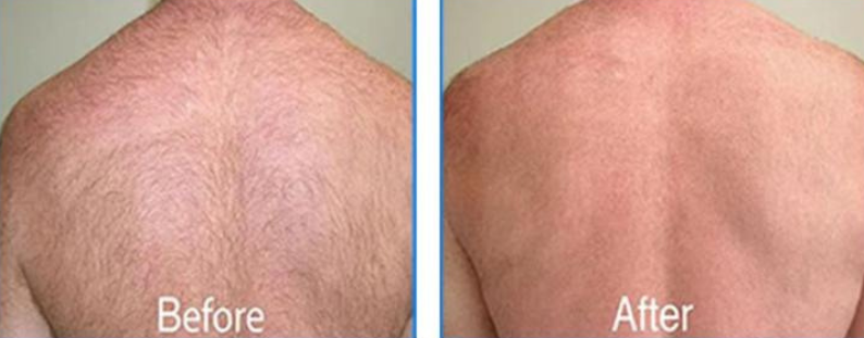 Full Body Hair Reduction Result