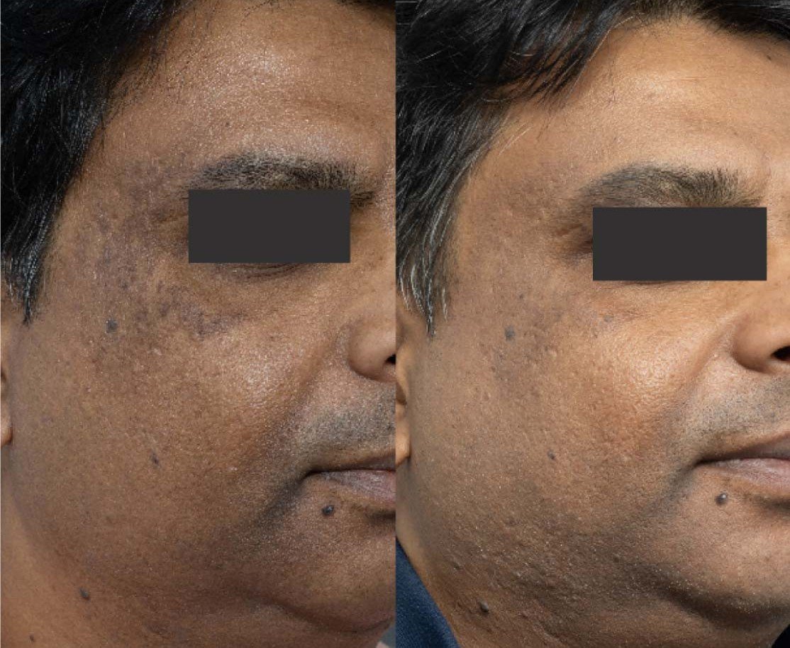 Acne scar and nevus treatment case 2