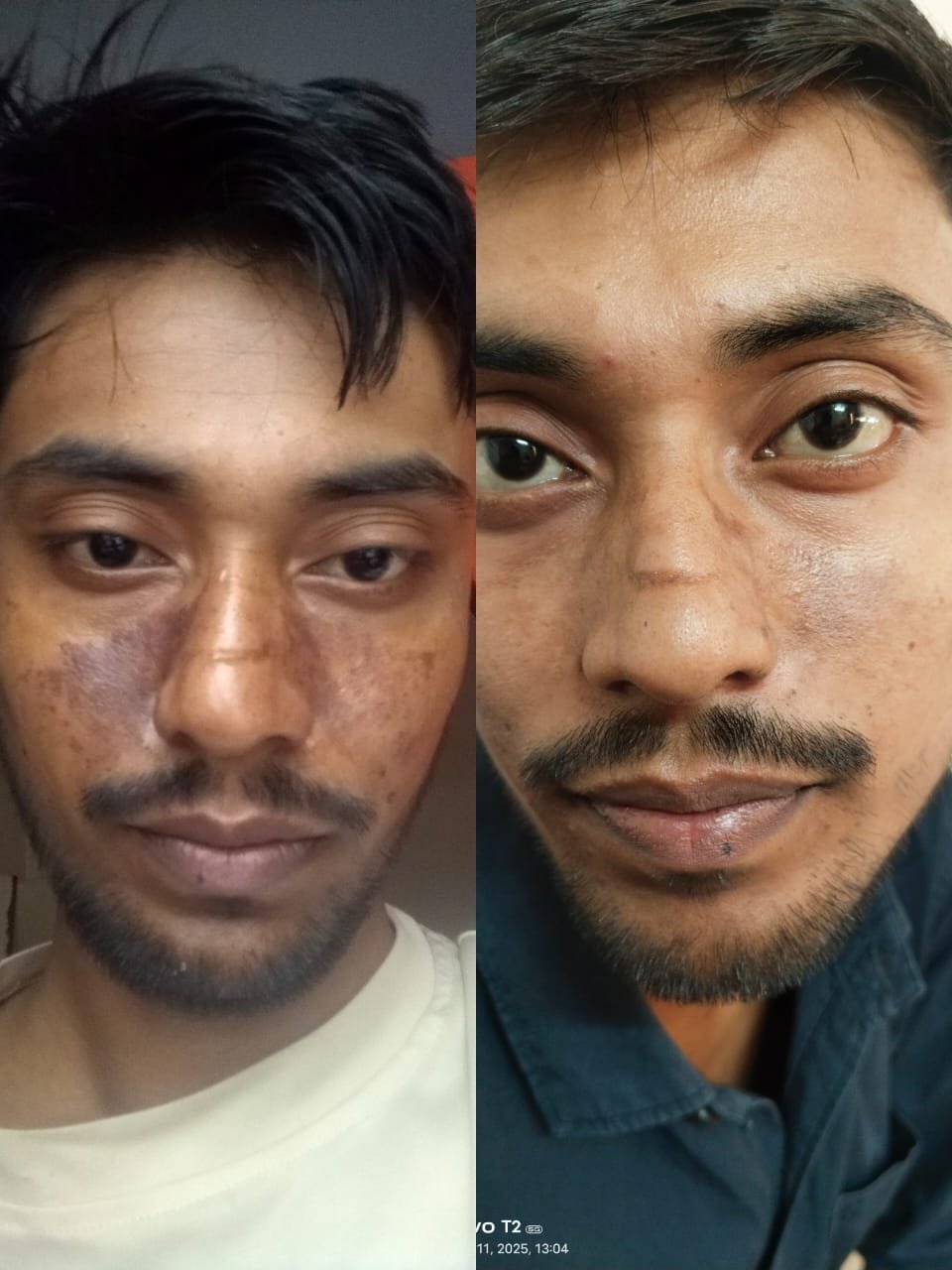 Acne scar and nevus treatment case 3