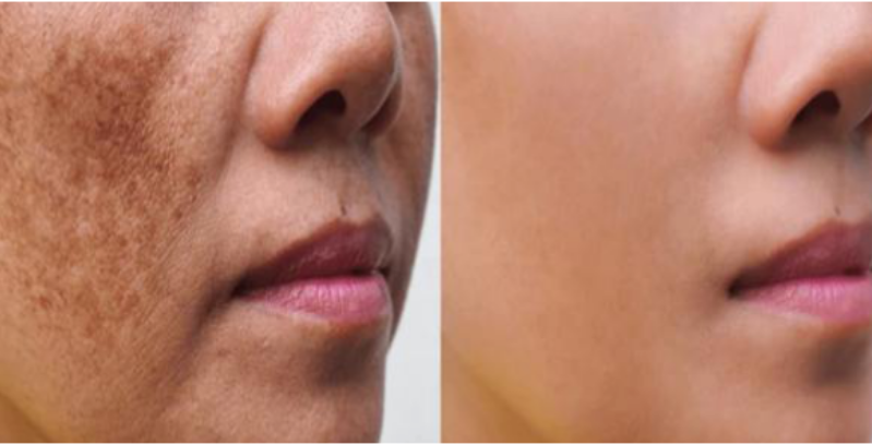 Pigment Melasma Result