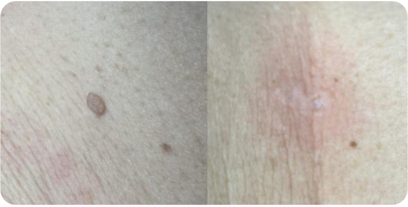 Skin Imperfections and Resurfacing Result