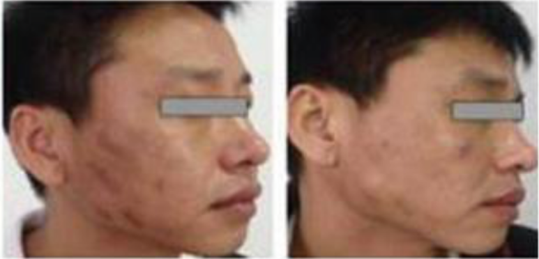 Acne scar, otanvus, blue nevus, black nevus