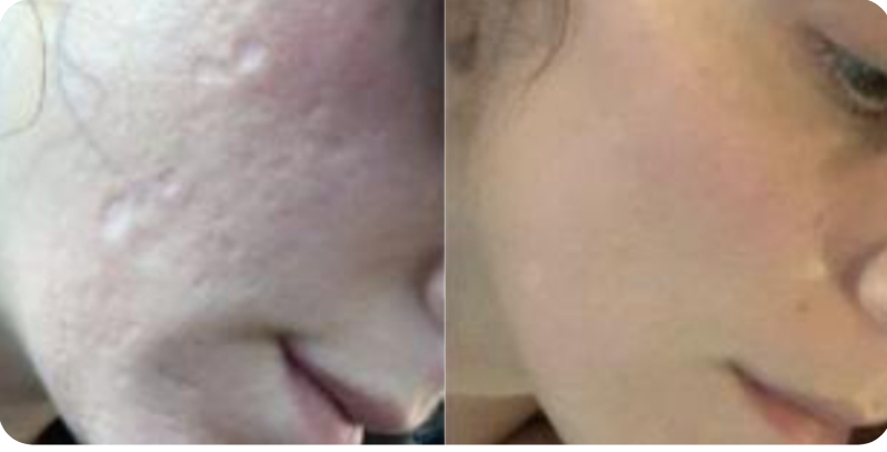 Skin Rejuvenation and Skin Tightening Result