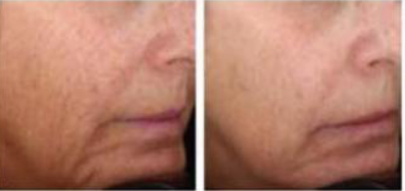 Skin Whitening and wrinkle removal